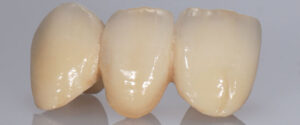 A porcelain 3 unit bridge. We make dental ceramic work for our surgery and local dentists in other dental practices.